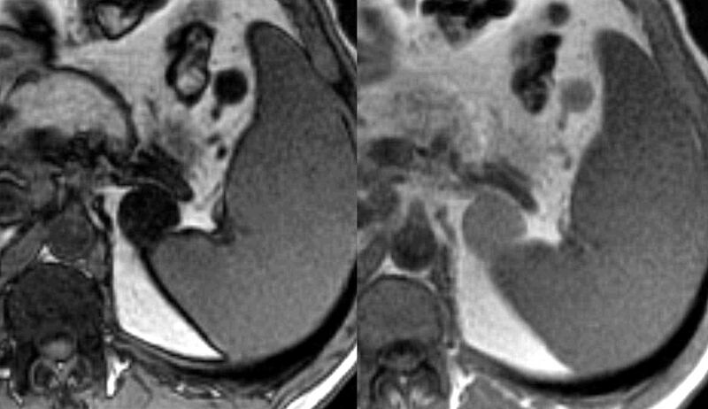 File:Adrenal adenoma (Radiopaedia 2600-6299 Axial MRI in and out of phase 1).jpg