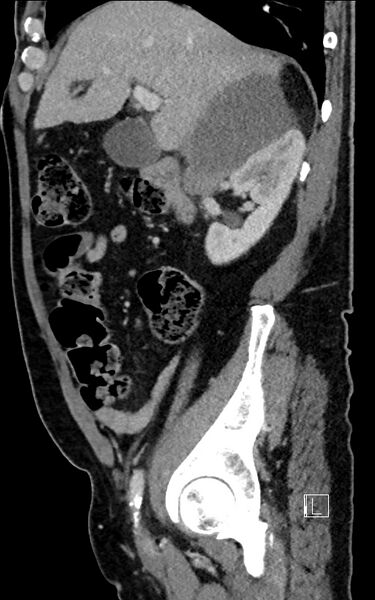 File:Adrenal lymphoma (Radiopaedia 73730-84529 Sagittal C+ portal venous phase 37).jpg
