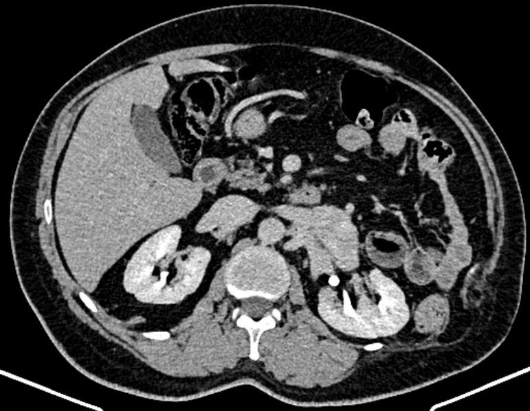File:Adrenal metastases (Radiopaedia 73082-83791 Axial C+ delayed 128).jpg