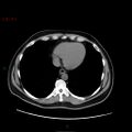 Ampullary carcinoma (Radiopaedia 56396-63056 Axial non-contrast 5).jpg