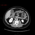 Ampullary carcinoma (Radiopaedia 56396-63056 C 51).jpg