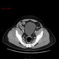 Ampullary carcinoma (Radiopaedia 56396-63056 C 85).jpg
