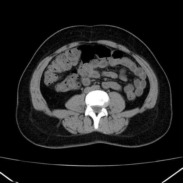 File:Ampullary tumor (Radiopaedia 22787-22816 Axial non-contrast 32).jpg