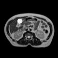 Ampullary tumor (Radiopaedia 27294-27479 T2 2).jpg
