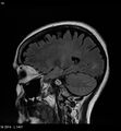 Amyotrophic lateral sclerosis (Radiopaedia 5373-7134 Sagittal FLAIR 6).jpg