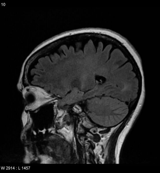 File:Amyotrophic lateral sclerosis (Radiopaedia 5373-7134 Sagittal FLAIR 6).jpg