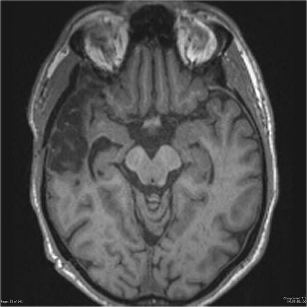 File:Anaplastic meningioma with recurrence (Radiopaedia 34452-35788 Axial T1 53).jpg