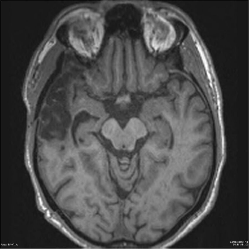 Anaplastic meningioma with recurrence (Radiopaedia 34452-35788 Axial T1 53).jpg