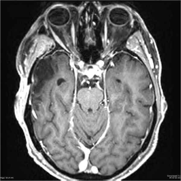 File:Anaplastic meningioma with recurrence (Radiopaedia 34452-35788 Axial T1 C+ 50).jpg
