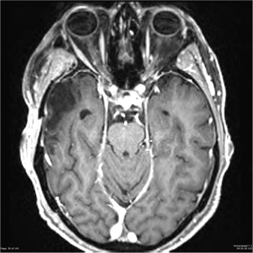Anaplastic meningioma with recurrence (Radiopaedia 34452-35788 Axial T1 C+ 50).jpg