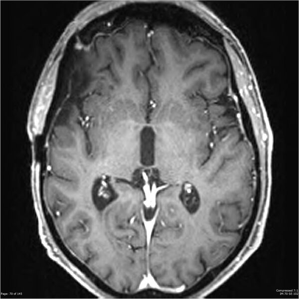 File:Anaplastic meningioma with recurrence (Radiopaedia 34452-35788 Axial T1 C+ 70).jpg