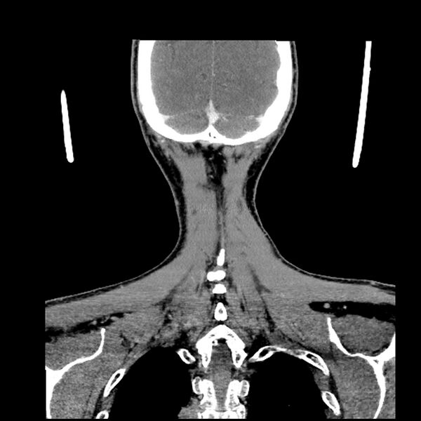 File:Anaplastic thyroid carcinoma (Radiopaedia 79087-92034 A 101).jpg