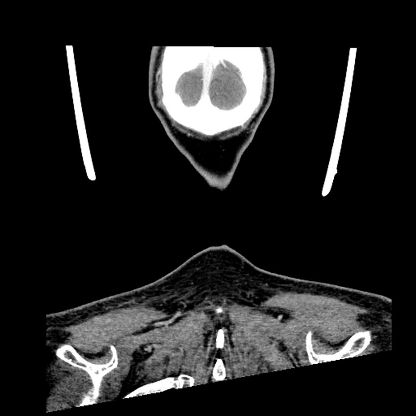 Anaplastic thyroid carcinoma (Radiopaedia 79087-92034 A 112).jpg
