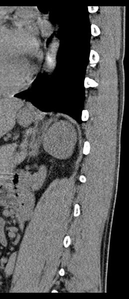 File:Aneurysmal bone cyst T11 (Radiopaedia 29294-29721 E 18).jpg