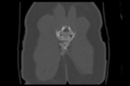 Aneurysmal bone cyst of ischium (Radiopaedia 25957-26094 Coronal bone window 44).png