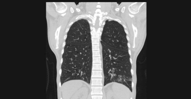 File:Angioinvasive aspergellosis (Radiopaedia 66995-76315 Coronal lung window 46).jpg
