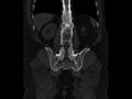 Ankylosing spondylitis (Radiopaedia 44609-48357 Coronal bone window 70).jpg