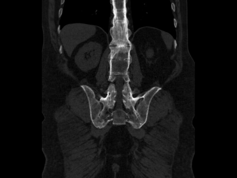 File:Ankylosing spondylitis (Radiopaedia 44609-48357 Coronal bone window 70).jpg