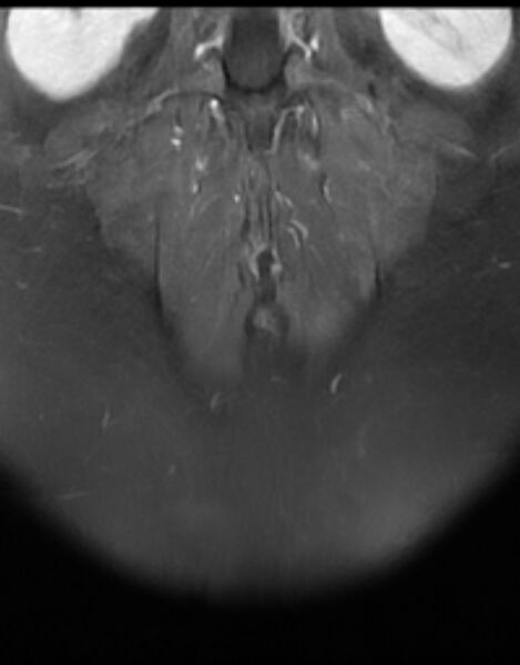File:Ankylosing spondylitis - Andersson lesion (Radiopaedia 81878-95838 H 14).jpg