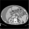 Annular pancreas and cirrhosis (Radiopaedia 24561-24843 A 2).jpg
