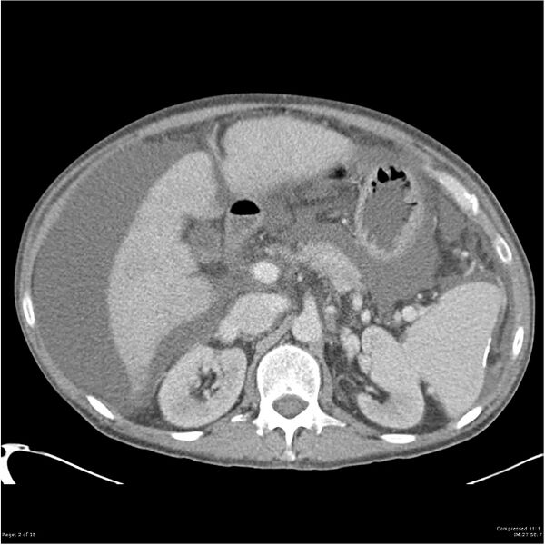 File:Annular pancreas and cirrhosis (Radiopaedia 24561-24843 A 2).jpg