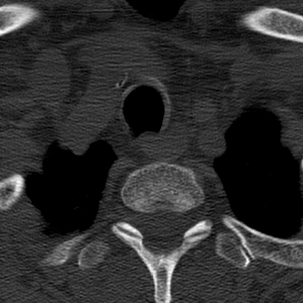 File:Anterior cervical postdiscectomy arthrodesis (Radiopaedia 32678-33646 Axial bone window 71).jpg