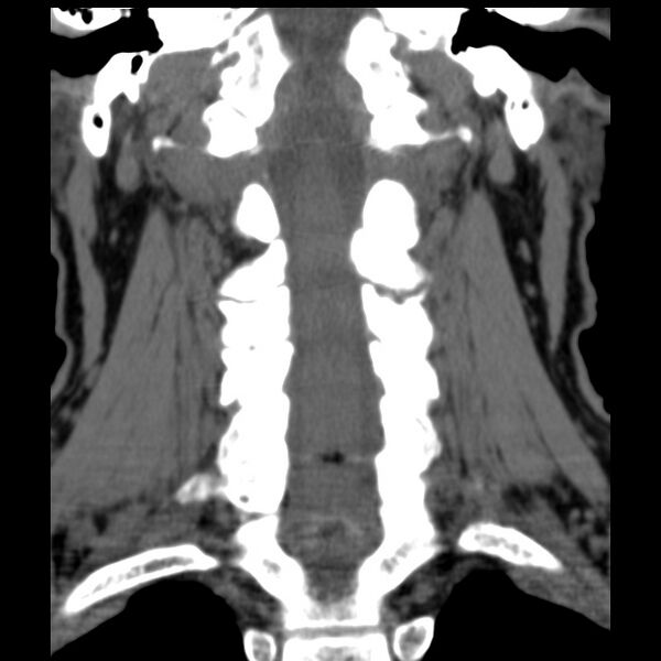 File:Anterior cervical postdiscectomy arthrodesis (Radiopaedia 32678-33646 Coronal non-contrast 19).jpg