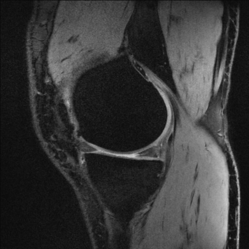 Anterior cruciate ligament mucoid degeneration (Radiopaedia 68400-77933 Sagittal 50).jpg