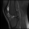 Anterior cruciate ligament tear, Wrisberg rip and bucket-handle tear of medial meniscus (Radiopaedia 75872-87266 Sagittal PD fat sat 11).jpg