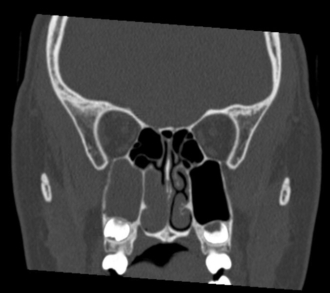 File:Antrochoanal polyp (Radiopaedia 21894-21868 Coronal bone window 19).jpg