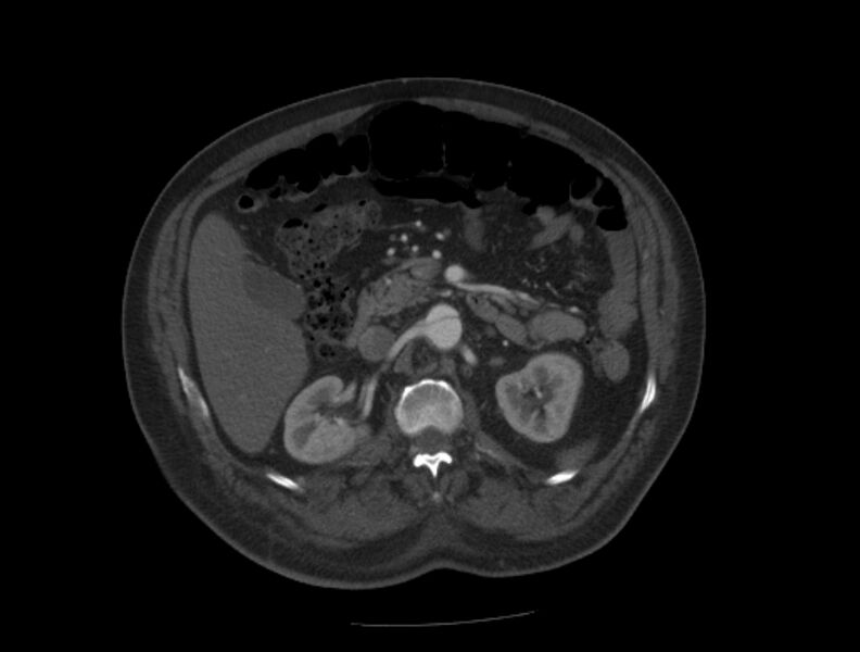 File:Aortic dissection (Radiopaedia 28802-29105 A 54).jpg