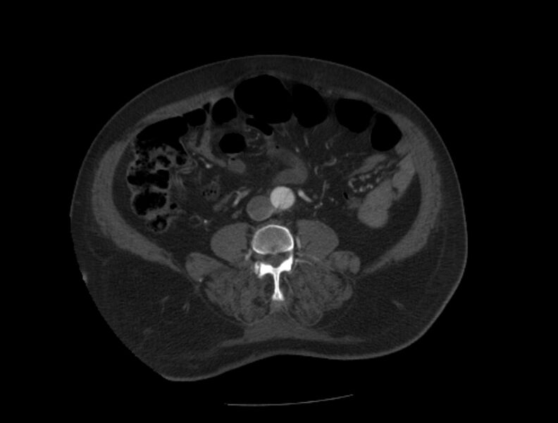 File:Aortic dissection (Radiopaedia 28802-29105 A 71).jpg