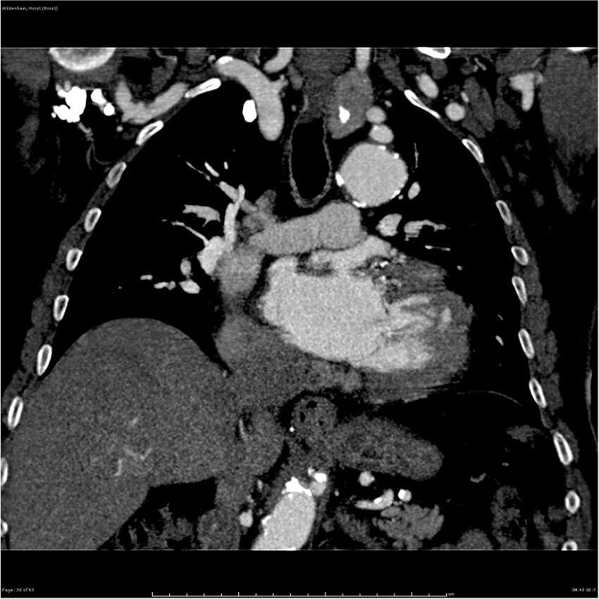 Aortic dissection - Stanford type A (Radiopaedia 26183-26315 A 30).jpg