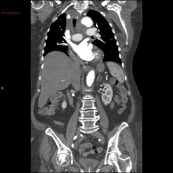 File:Aortic intramural hematoma (Radiopaedia 27746-28001 B 30).jpg