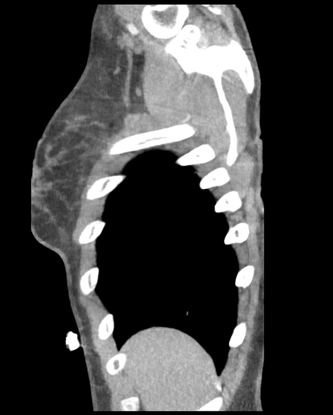 File:Aortic valve non-coronary cusp thrombus (Radiopaedia 55661-62189 D 48).png