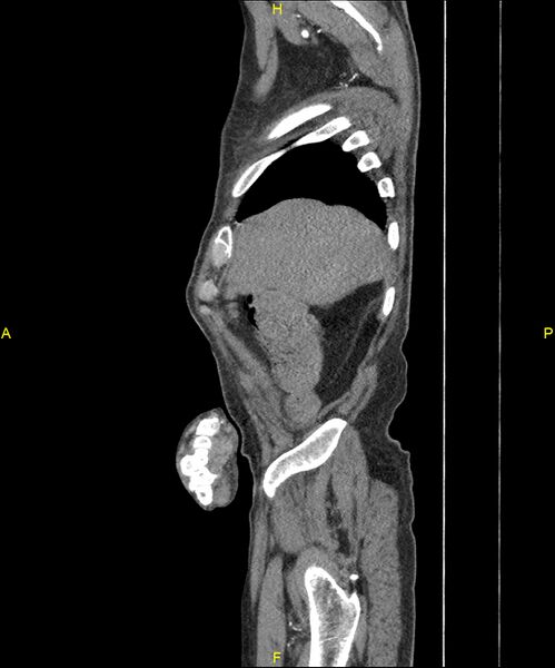 File:Aortoenteric fistula (Radiopaedia 84308-99603 C 46).jpg