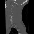 Apical pneumothorax on cervical spine CT (Radiopaedia 45343-49368 Sagittal bone window 31).jpg