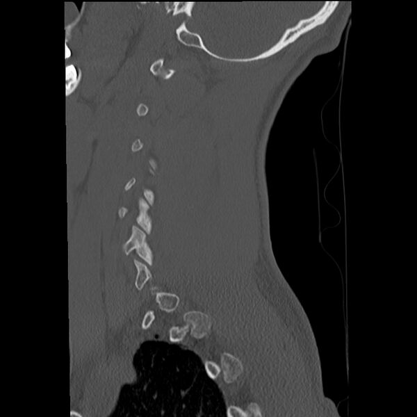 File:Apical pneumothorax on cervical spine CT (Radiopaedia 45343-49368 Sagittal bone window 31).jpg