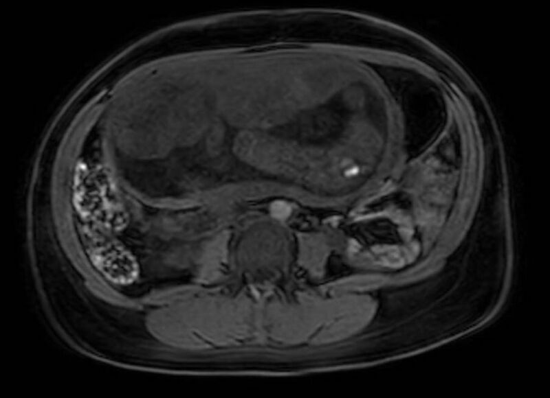 File:Appendicitis in gravida (MRI) (Radiopaedia 89433-106395 Axial DIXON 71).jpg