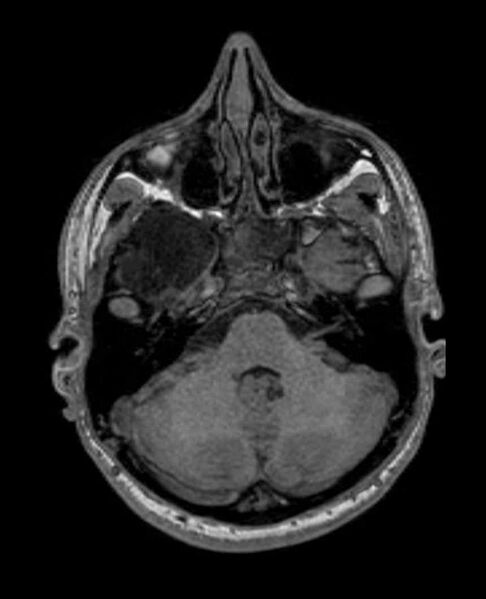 File:Arachnoid cyst- extremely large (Radiopaedia 68741-78451 Axial T1 19).jpg