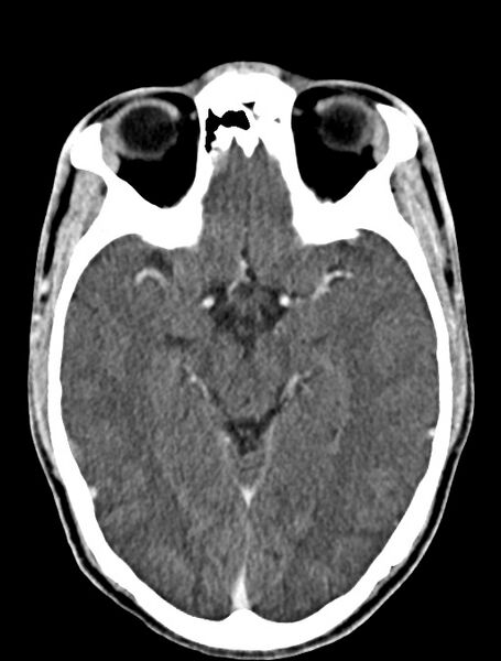 File:Arrow injury to the face (Radiopaedia 73267-84011 Axial C+ delayed 49).jpg