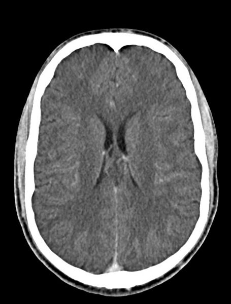 File:Arrow injury to the face (Radiopaedia 73267-84011 Axial C+ delayed 59).jpg
