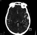Arteriovenous malformation - cerebral (Radiopaedia 8172-14682 A 10).jpg