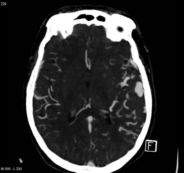 File:Arteriovenous malformation - cerebral (Radiopaedia 8172-14682 A 10).jpg