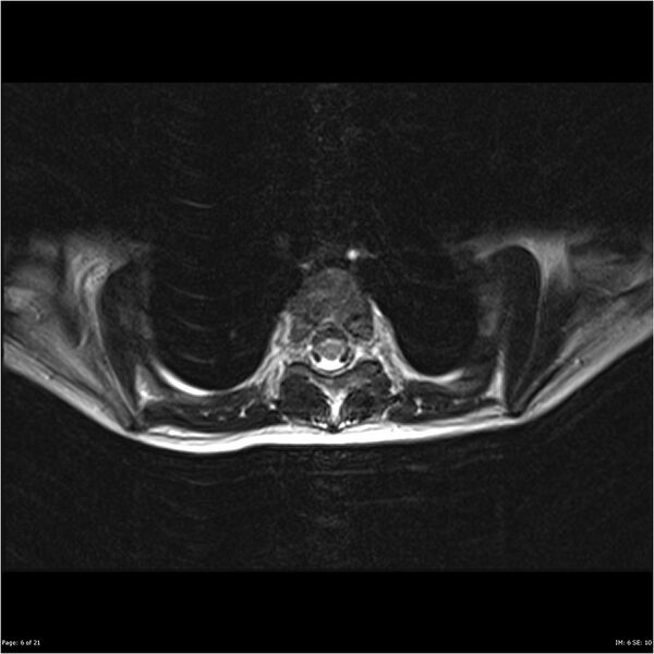 File:Arthrogryposis and muscle atrophy (Radiopaedia 24081-24314 B 6).jpg