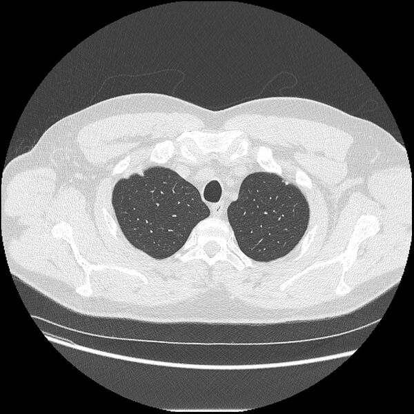File:Asbestosis (Radiopaedia 45002-48961 Axial lung window 7).jpg