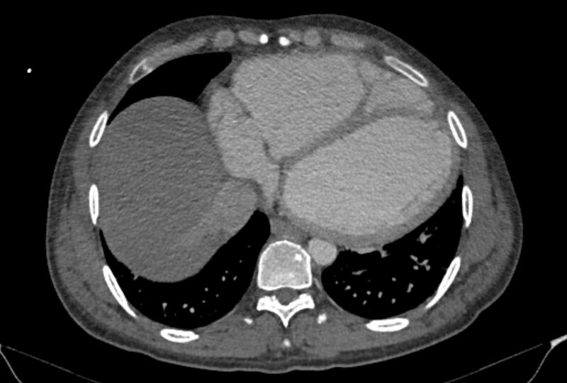 File:Ascending aortic aneurysm (Radiopaedia 86279-102297 C 50).jpg