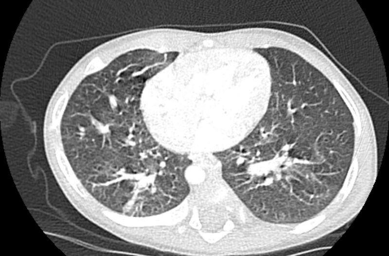 File:Asplenia syndrome (Radiopaedia 73083-83792 Axial lung window 48).jpg