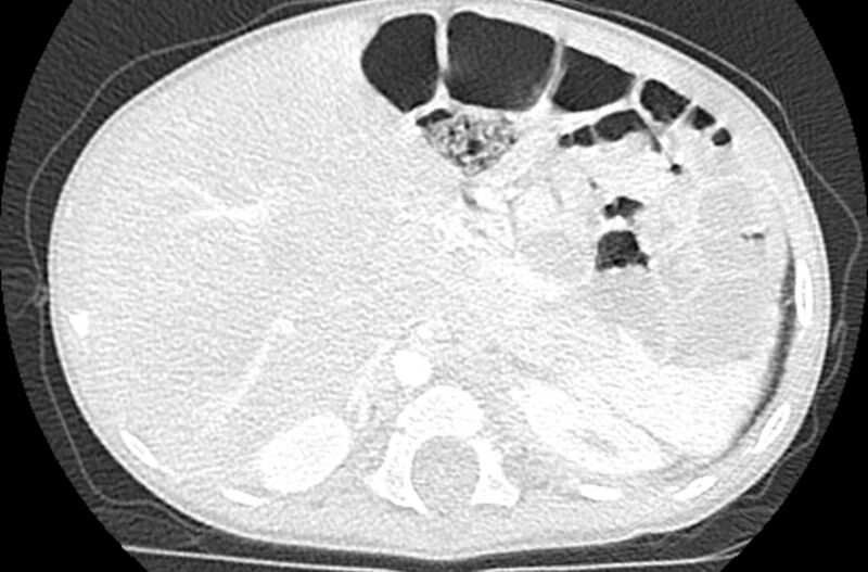 File:Asplenia syndrome (Radiopaedia 73083-83792 Axial lung window 77).jpg