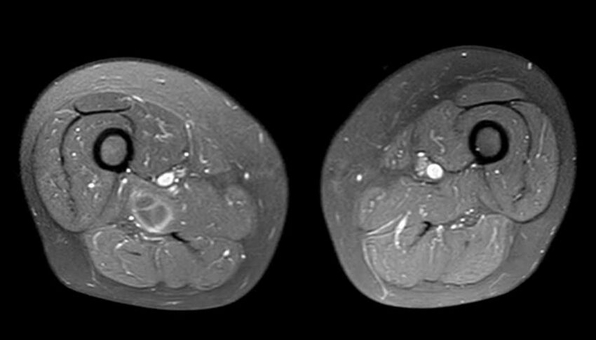 Atypical lipomatous tumor - thigh (Radiopaedia 68975-78734 Axial PD fat sat 47).jpg